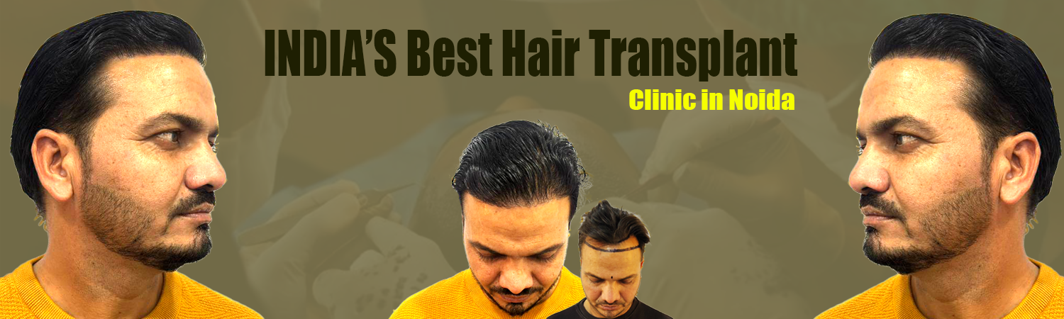 crown density best hair transplant clinic in Noida