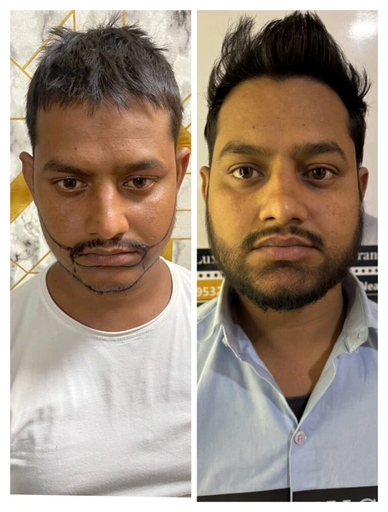 Beard Transplant Procedure