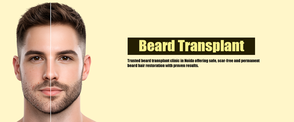 Beard Hair Transplant in Noida